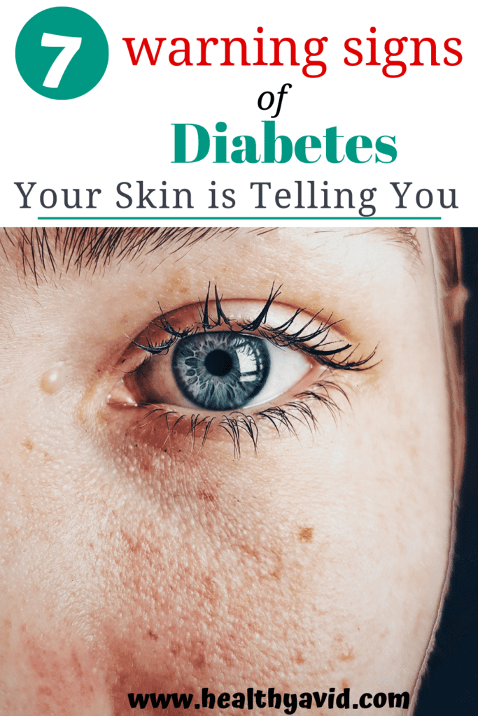 7 Warning Signs Of Diabetes Your Skin Is Telling You