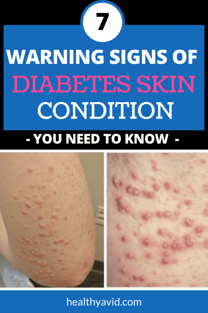 diabetes and skin conditions- warning signs