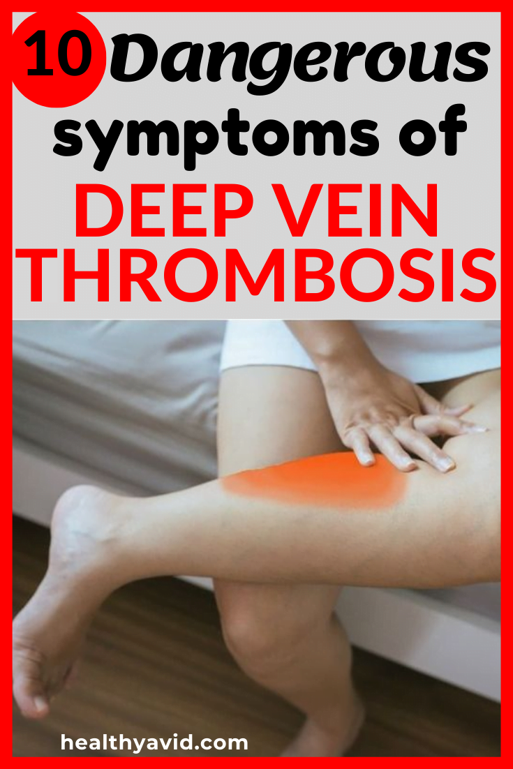 10 Symptoms of Deep Vein Thrombosis
