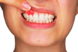 symptoms of diabetes inflamed gum (1)