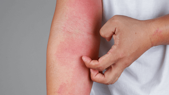 skin allergy- chicory side effects (1)