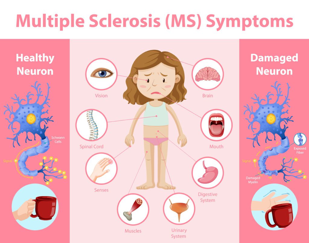 early signs and sympptoms of MS
