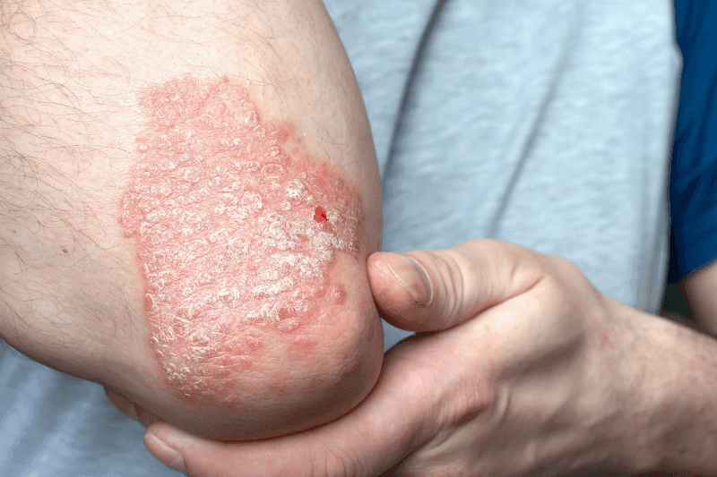 Causes of Psoriatic Arthritis-healthyavid.com