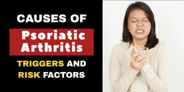Causes of Psoriatic Arthritis_HEALTHYAVID.COM